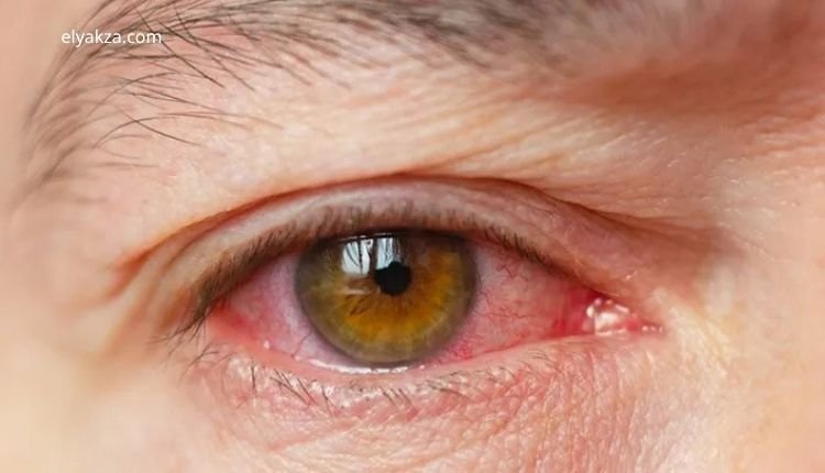 دليل شامل لعلاج جفاف العين وأسبابه وطرق الوقاية منه 1 علاج جفاف العين