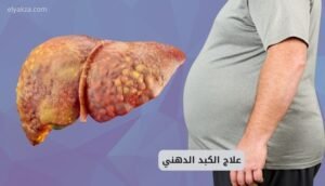 علاج الكبد الدهني