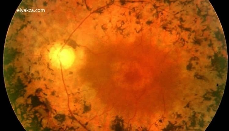 علاج التهاب الشبكية الصباغي وتجديد العصب البصري: ثورة طبية قادمة 4 علاج التهاب الشبكية الصباغي