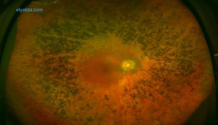 علاج التهاب الشبكية الصباغي وتجديد العصب البصري: ثورة طبية قادمة 3 التهاب الشبكية الصباغي